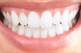 Teeth Whitening services at Main Street Dental Office in Brampton